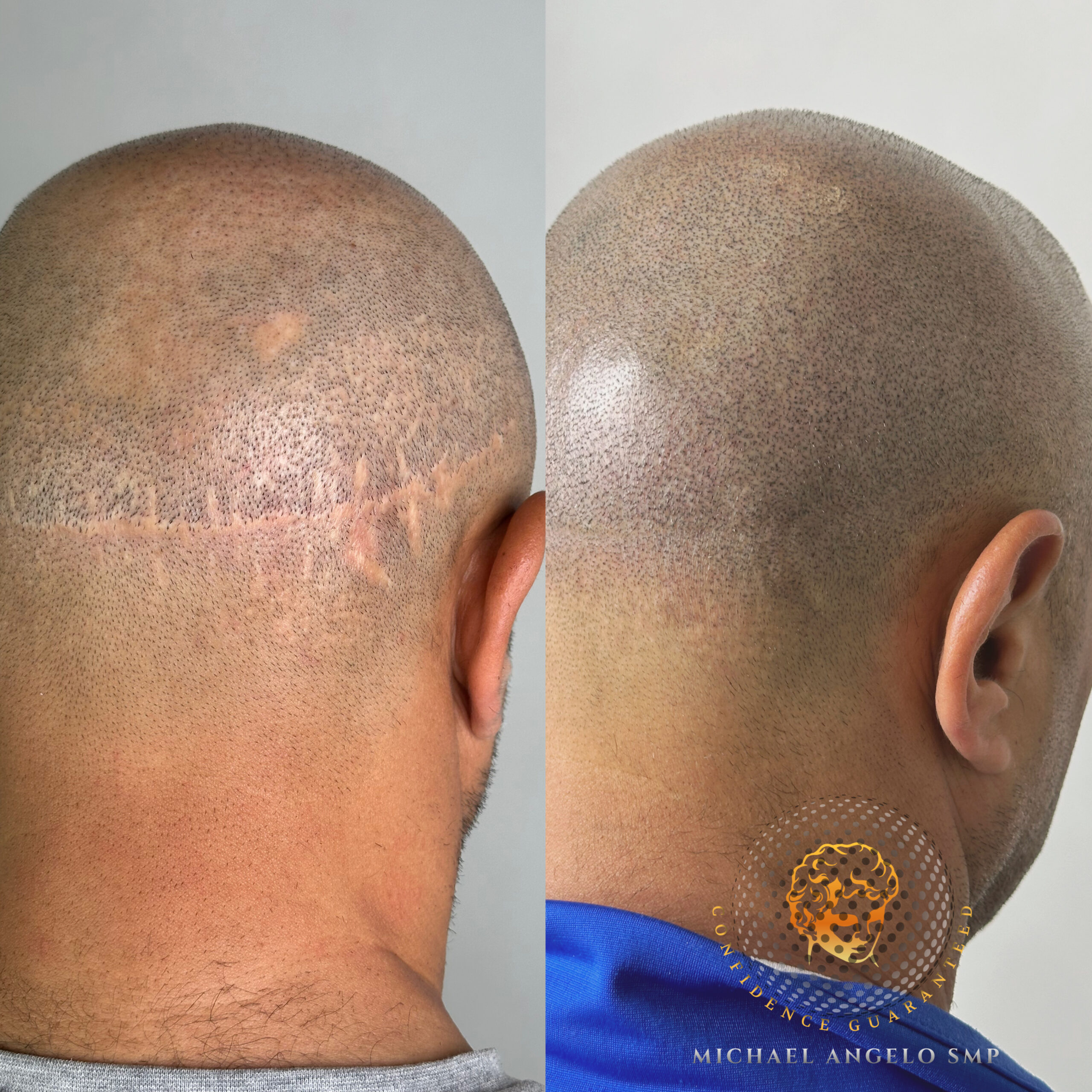 Scalp Micropigmentation Scar Camouflaging Before & After using  SMP. Treatment by Michael Angelo SMP.