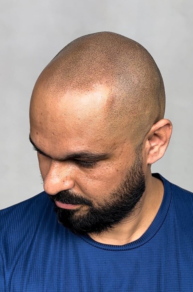 How long will SMP Last? well Client B on the right shows The results of SMP touch up maintenance. Is scalp micropigmentation permanent? No, but This results in a fresh look every 2 years. Maintaining scalp micropigmentation is crucial.