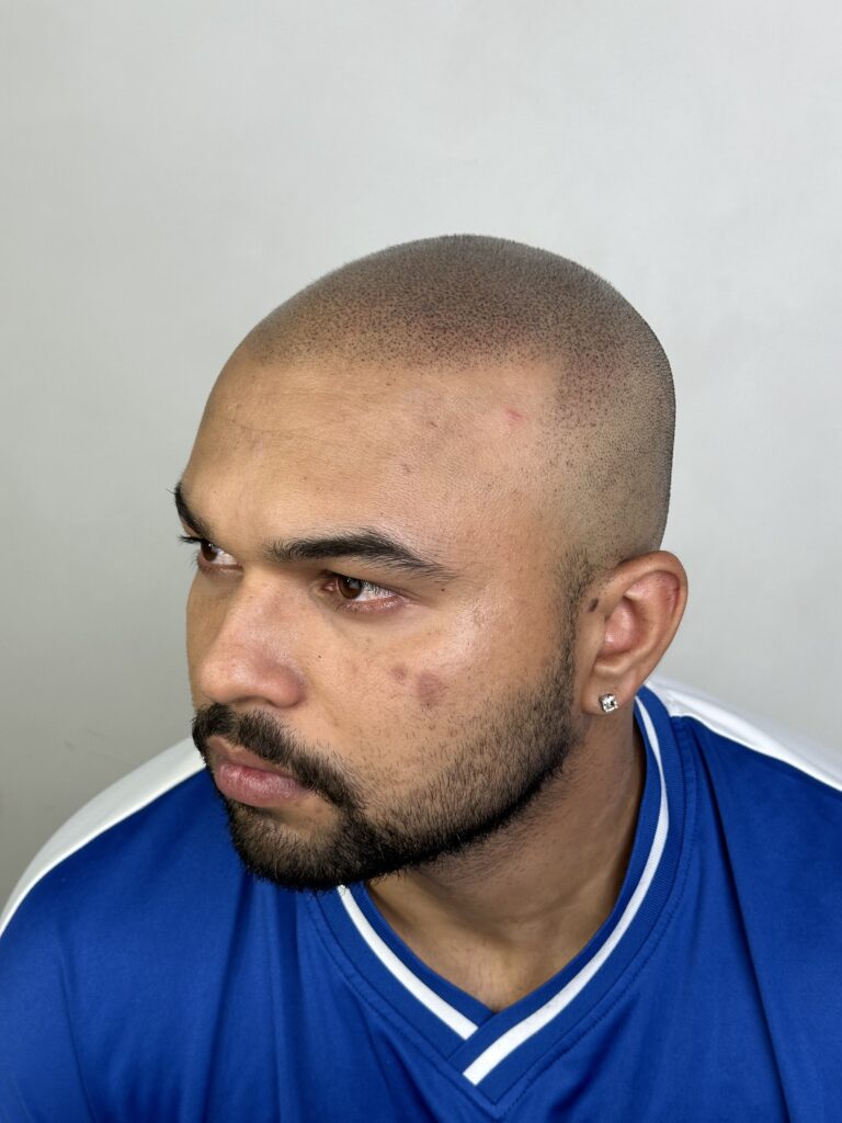 Client A on the left, shows a perfect example of scalp micropigmentation not being permanent. The questions of, Is scalp micropigmentation permanent? Is no. However, a touch up every 2-3 years fixes this issue. fading can occur as shown, which can be a good thing, as you can change and adapt your style with age if you like.