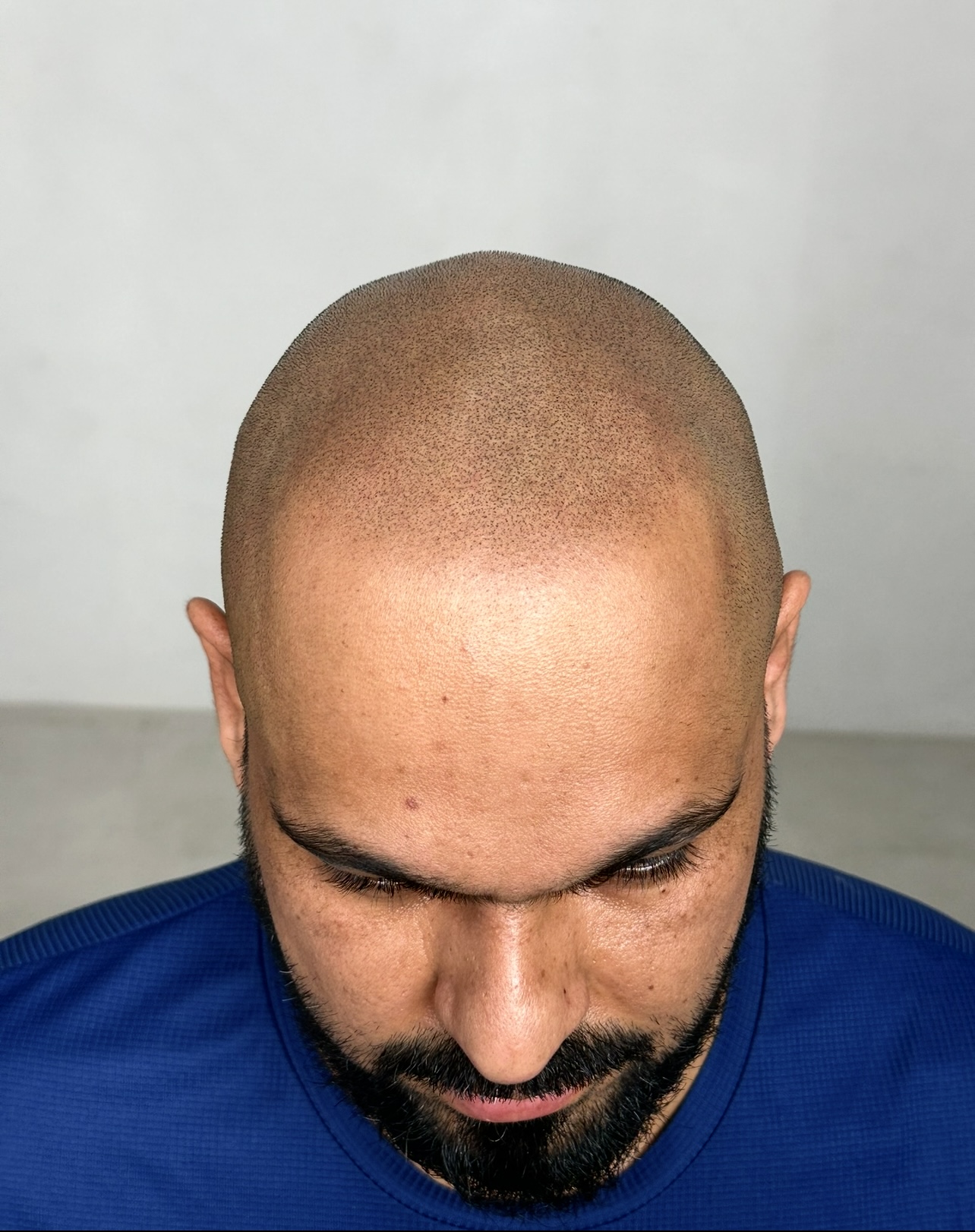 Scalp Micropigmentation results after photo taken and treatment by Michael Angelo SMP. After photo displays Scalp micro pigmentation treatment of Hairline Restoration for client suffering from hairloss. 