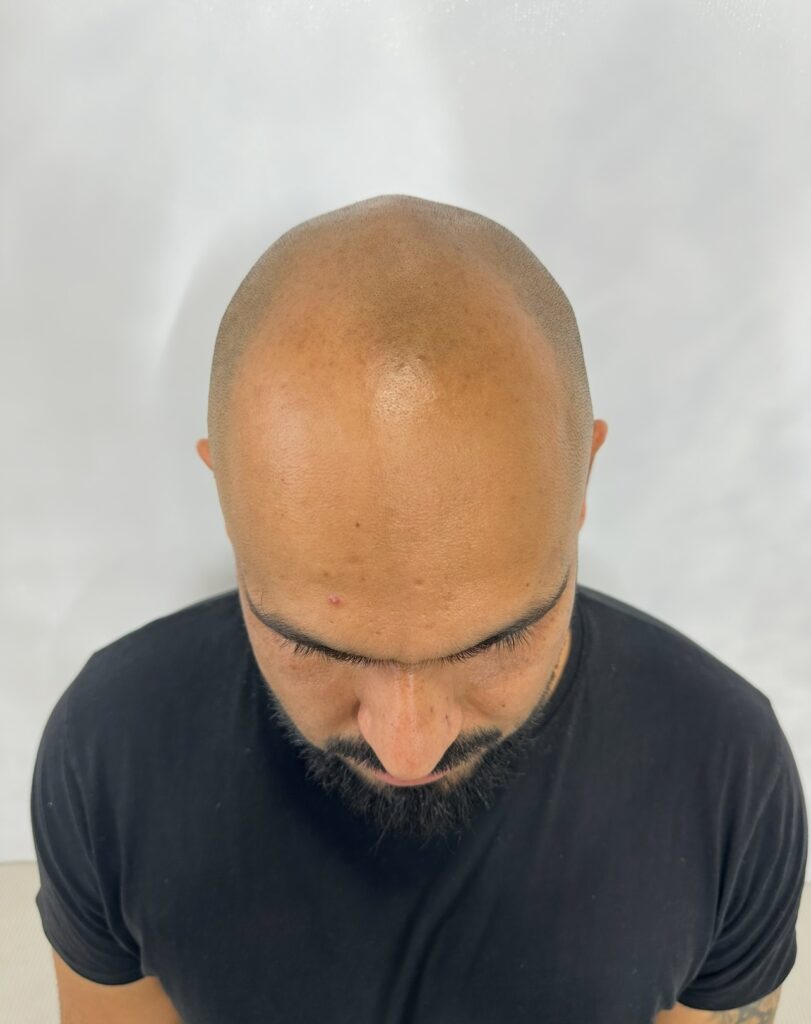 Scalp Micropigmentation before photo taken by Michael Angelo SMP. Example is client with non existent hairline. Before photo taken before procedure for client reference and Social Media.