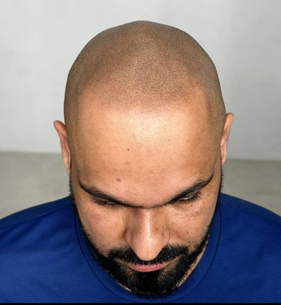 "Austin Scalp Micropigmentation pricing table" Shaved head treatment cost 2500 USD. Done correctly.