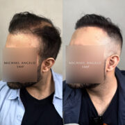 Before-and-after side profile images of a man who underwent scalp micropigmentation (SMP) to enhance his receding hairline, creating a denser and more youthful appearance.