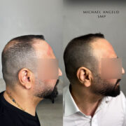 "Scalp micropigmentation (SMP) before and after for a man with hair loss. The procedure enhances hair density, restoring a natural and youthful hairline."