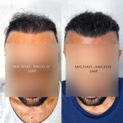 Before-and-after front-facing images of a man who received scalp micropigmentation (SMP) to restore his receding hairline, achieving a fuller and more youthful appearance.