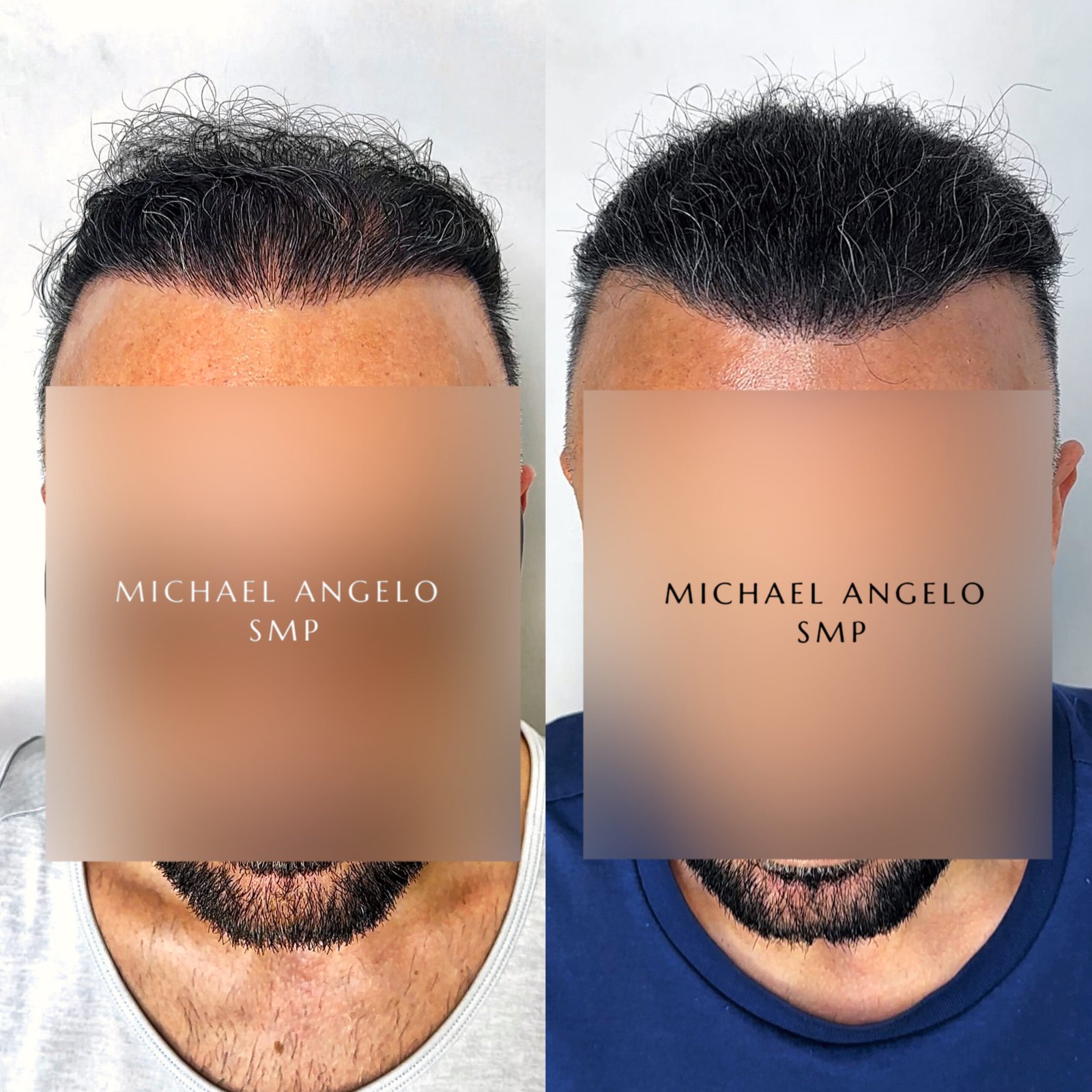 Hair density scalp micropigmentation client result