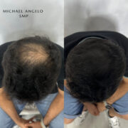 Before-and-after top view of a man with a significant crown balding area restored using scalp micropigmentation (SMP), creating a fuller, natural-looking appearance.