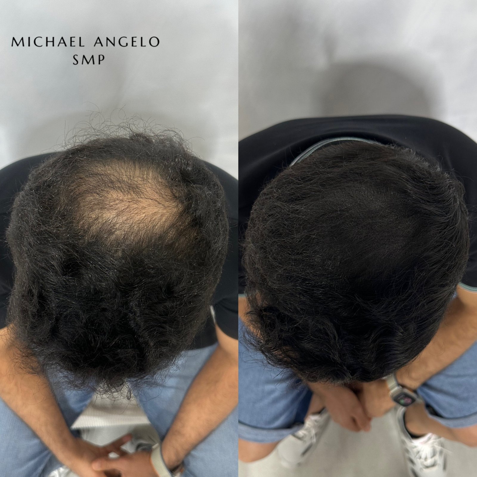 Hair micropigmentation density result Michael Angelo SMP