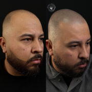 Before-and-after front-facing images of a man who received scalp micropigmentation (SMP) to restore his receding hairline, achieving a fuller and more youthful appearance.