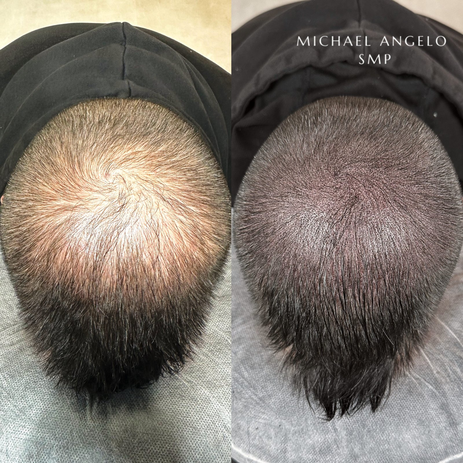 Hair micropigmentation density SMP before and after result by Michael Angelo SMP
