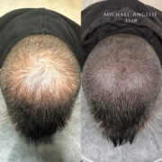 "Scalp micropigmentation (SMP) before and after for crown hair loss. The treatment replicates hair follicles, restoring natural scalp density."