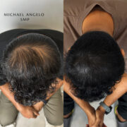 "Scalp micropigmentation (SMP) before and after treatment on a man with long hair, effectively covering thinning areas and increasing hair density."