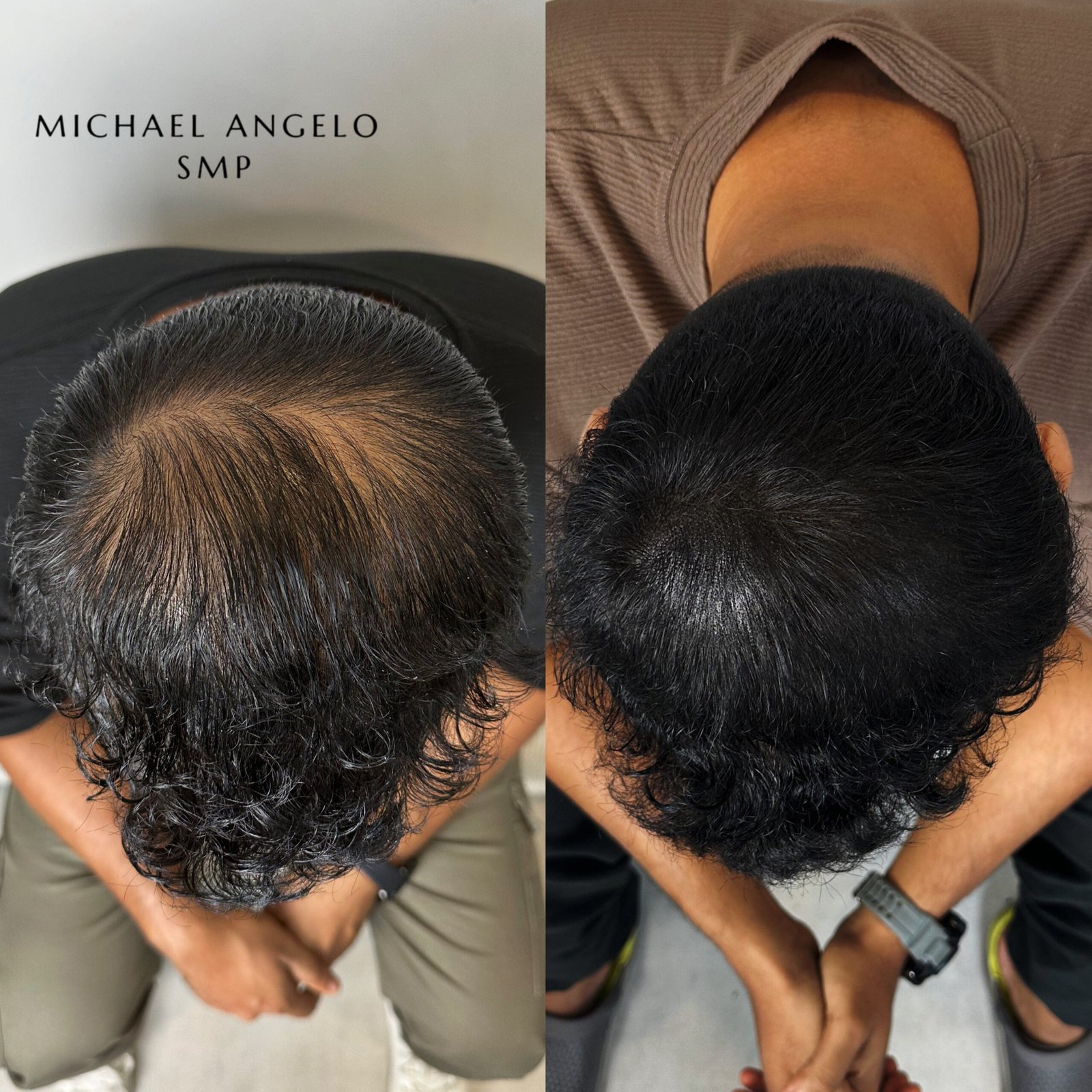 Density scalp micropigmentation before and after by Michael Angelo SMP in Austin Texas