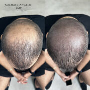 "Before and after scalp micropigmentation (SMP) results on a man with severe crown thinning. The left image highlights significant scalp exposure due to hair loss, while the right image showcases a natural, shaved-head effect with increased density after SMP."