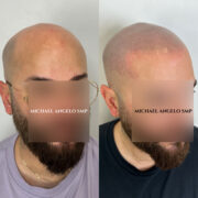 "Scalp micropigmentation (SMP) before and after treatment on a fully bald man, creating the appearance of natural hair follicles and a clean buzz-cut style."