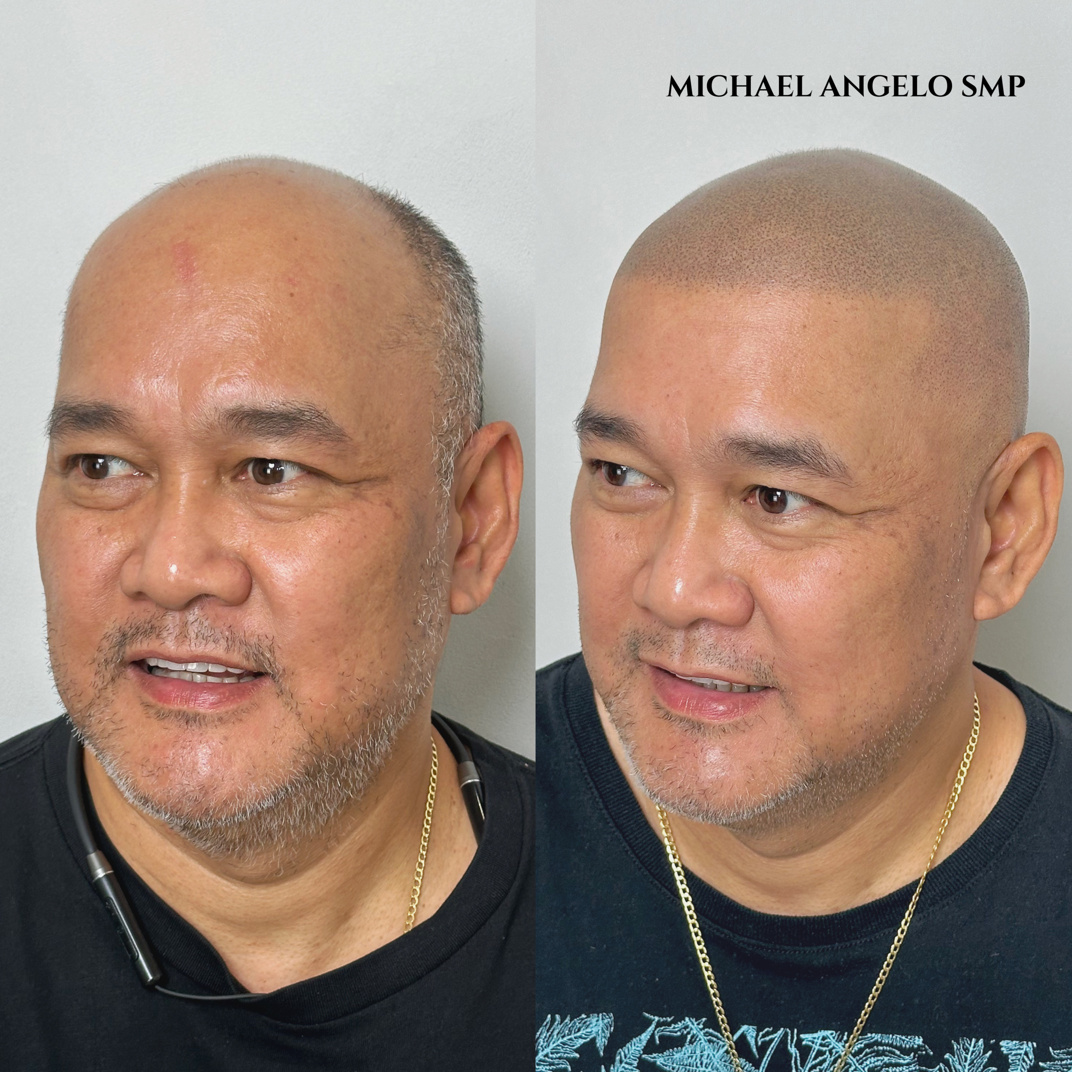 "Scalp micropigmentation (SMP) before and after results for a man with hair loss. The treatment replicates hair follicles, restoring a natural shaved look."