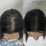 Before-and-after images of a woman who underwent scalp micropigmentation (SMP) to enhance hair density. The thinning hair at the crown has been seamlessly blended, creating a fuller, thicker appearance.