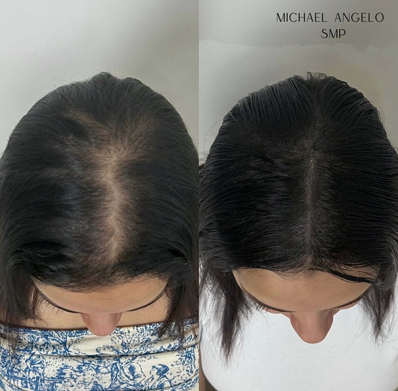 Female hair density scalp micropigmentation result