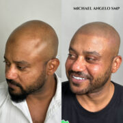 "Scalp micropigmentation (SMP) before and after treatment for full baldness. The procedure creates a natural, shaved-head appearance with realistic follicle detailing."