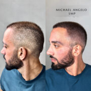 Before-and-after side profile of a man with a fuller, more defined hairline after scalp micropigmentation (SMP) treatment.