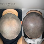 "Scalp micropigmentation (SMP) before and after treatment for hair loss. The procedure enhances scalp coverage, creating a seamless and realistic shaved-head effect."