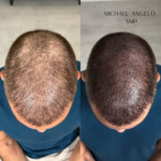 Before-and-after top view of a man with thinning hair, showing a dramatic improvement in hair density after scalp micropigmentation (SMP), achieving a natural, fuller look.