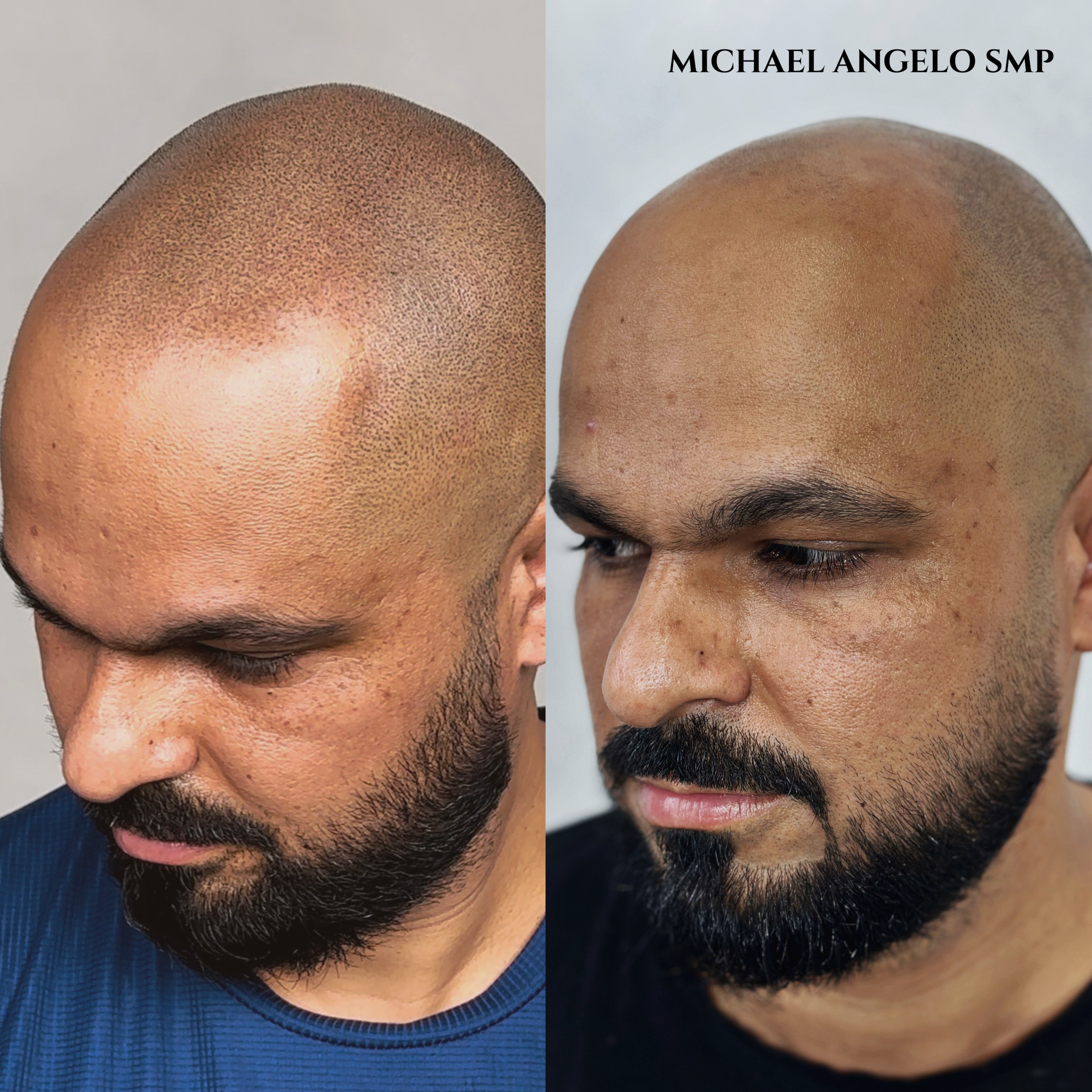 "Scalp micropigmentation (SMP) before and after treatment on a man with a receding hairline and full baldness, creating the appearance of natural stubble and a well-defined hairline."