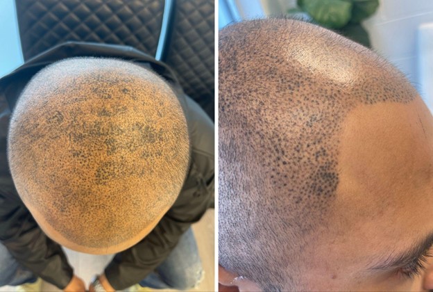 Is Scalp Micropigmentation Permanent? Yes if it is done incorrectly. SMP can be permanent if the artist is inexperienced and goes too deep into the skin. This is an example of what we call a blowout. SMP supposed to fade overtime allowing flexibility.