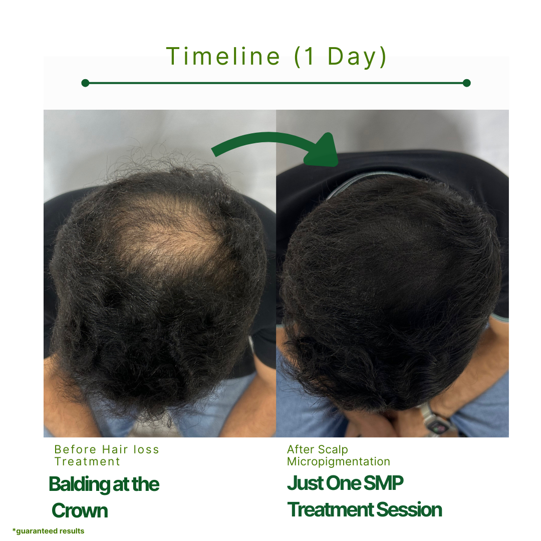 Before and after SMP density treatment following a hair transplant