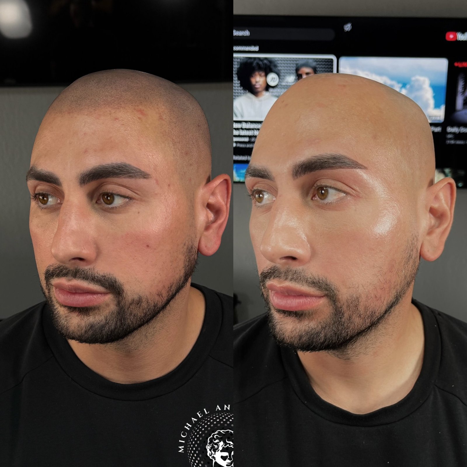 6 Shaved head SMP before and after
