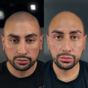 "Scalp micropigmentation (SMP) before and after treatment for full baldness. The procedure creates a natural, shaved-head appearance with realistic follicle detailing."