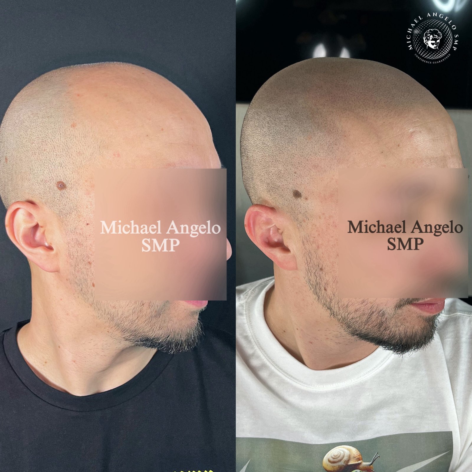 5 Shaved head scalp micropigmentation transformation