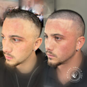 "Scalp micropigmentation (SMP) before and after results for a man with hair loss. The treatment replicates hair follicles, restoring a natural shaved look."