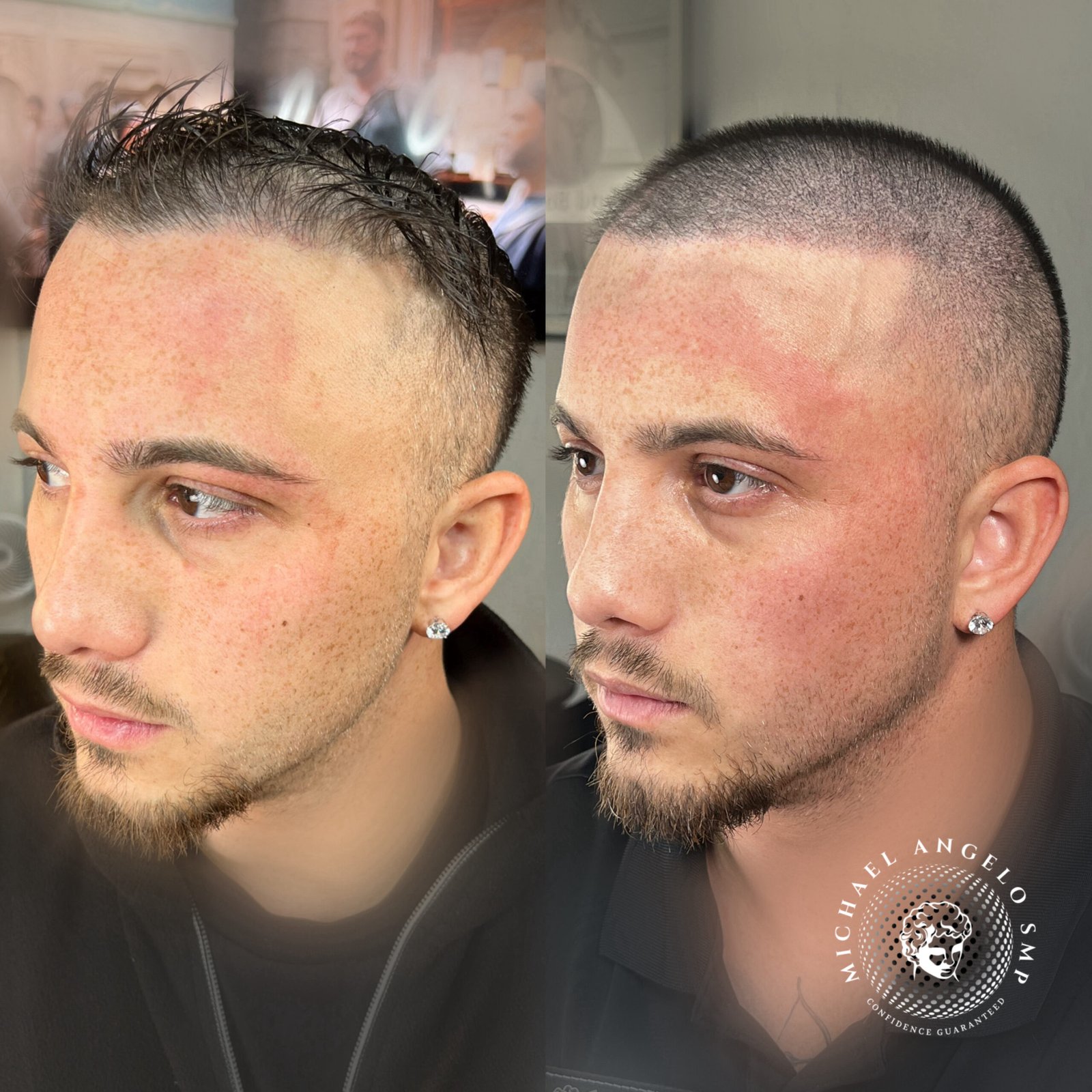 Hybrid density scalp micropigmentation result by Michael Angelo SMP