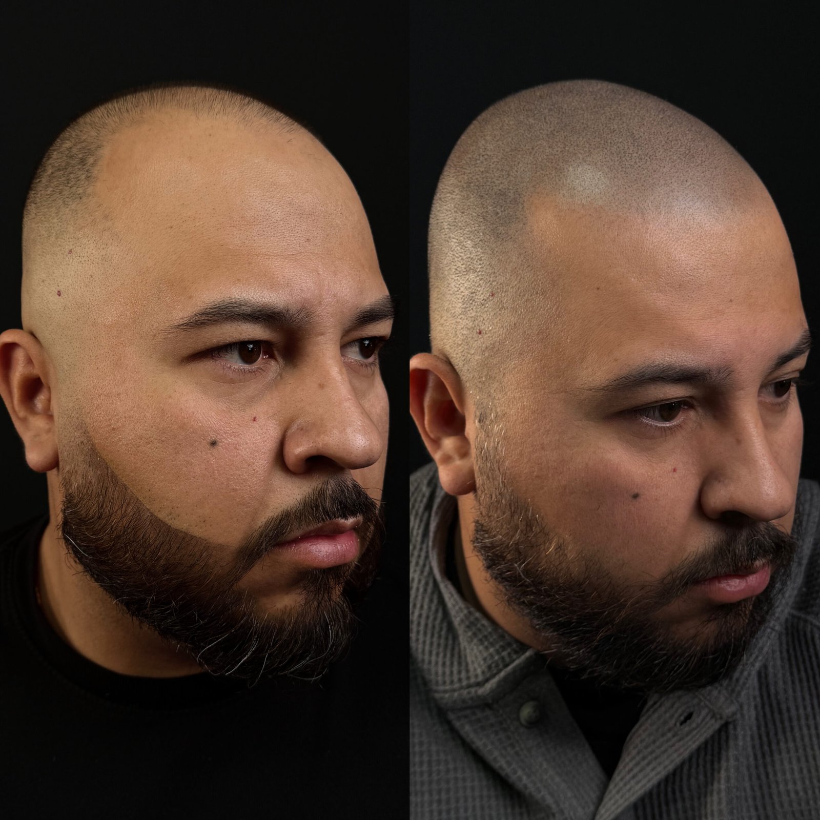 4 Scalp micropigmentation shaved head result