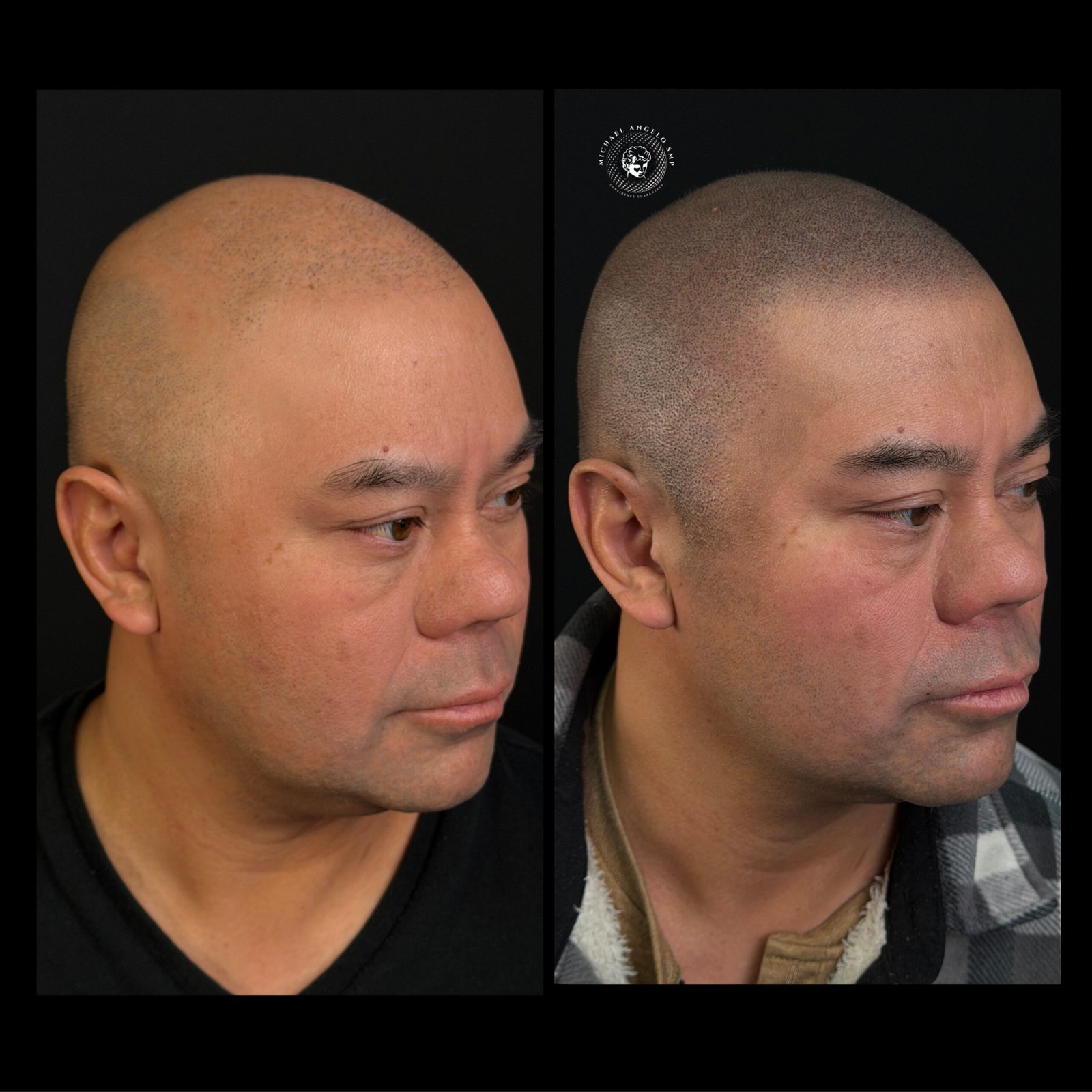 3 Shaved head SMP before and after result