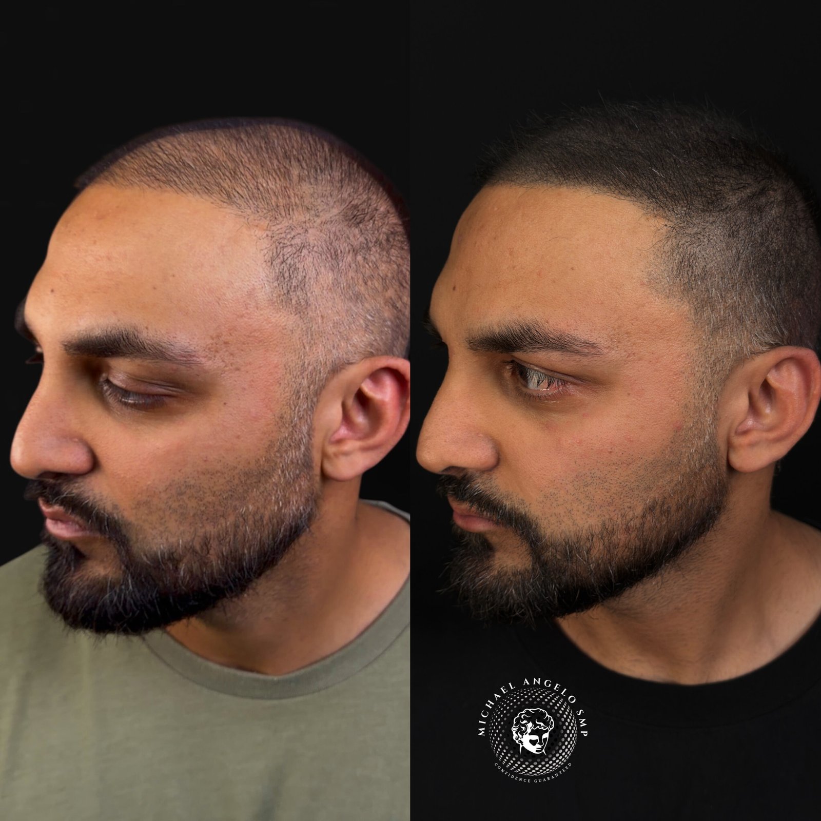 Scalp micropigmentation density treatment result Austin Texas