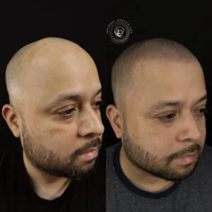 17 Shaved head SMP result