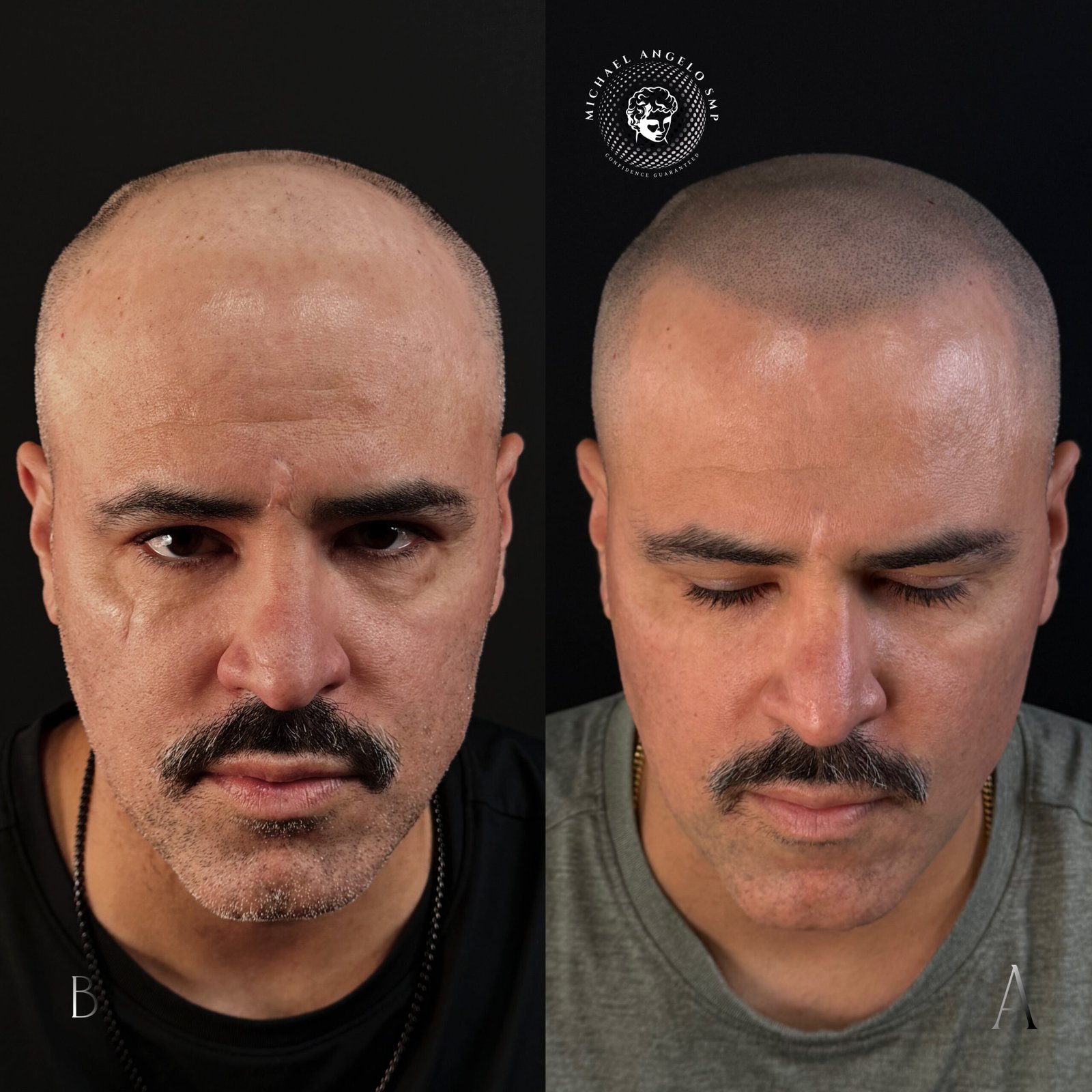 10 Scalp micropigmentation shaved head client result