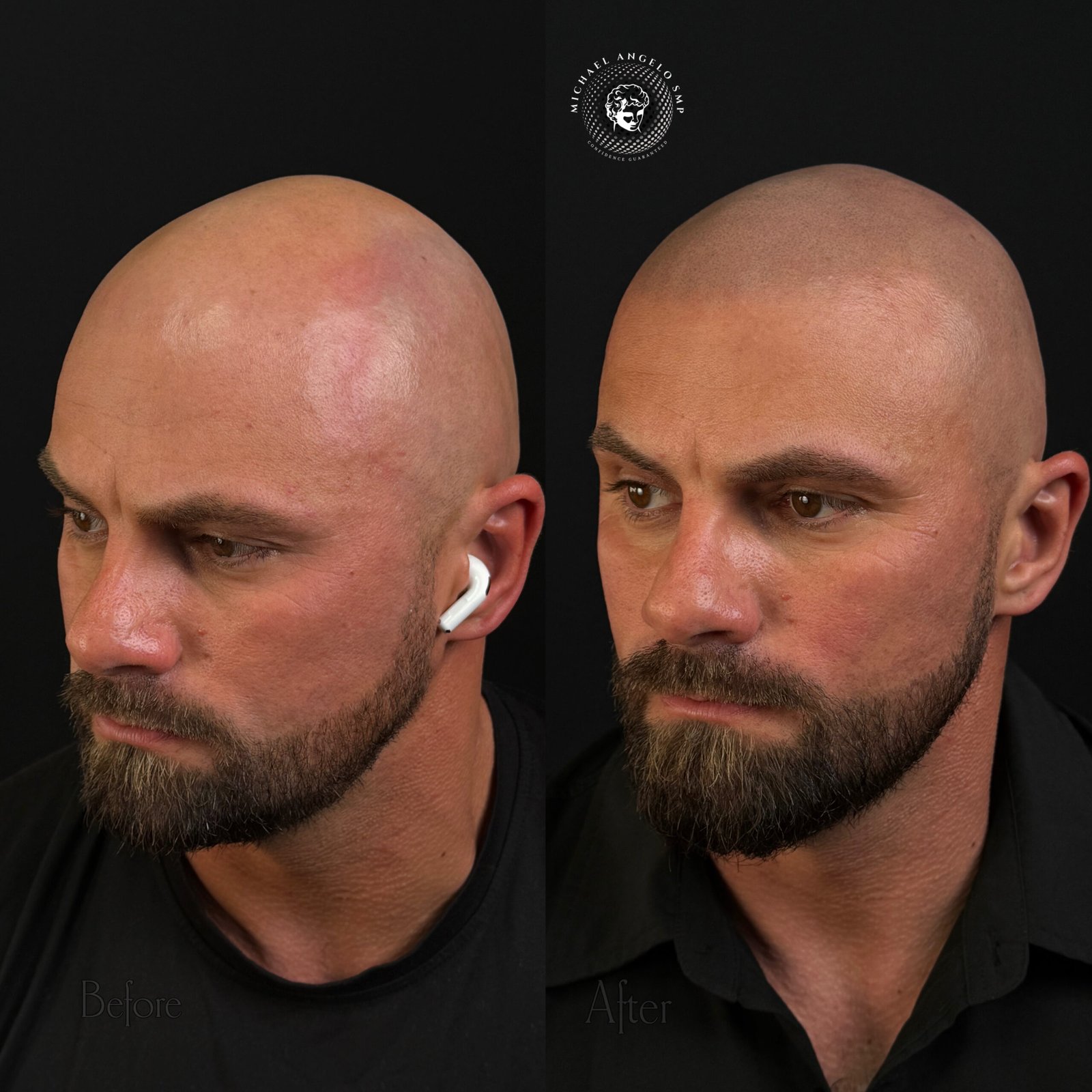 14 Hairline reconstruction with scalp micropigmentation