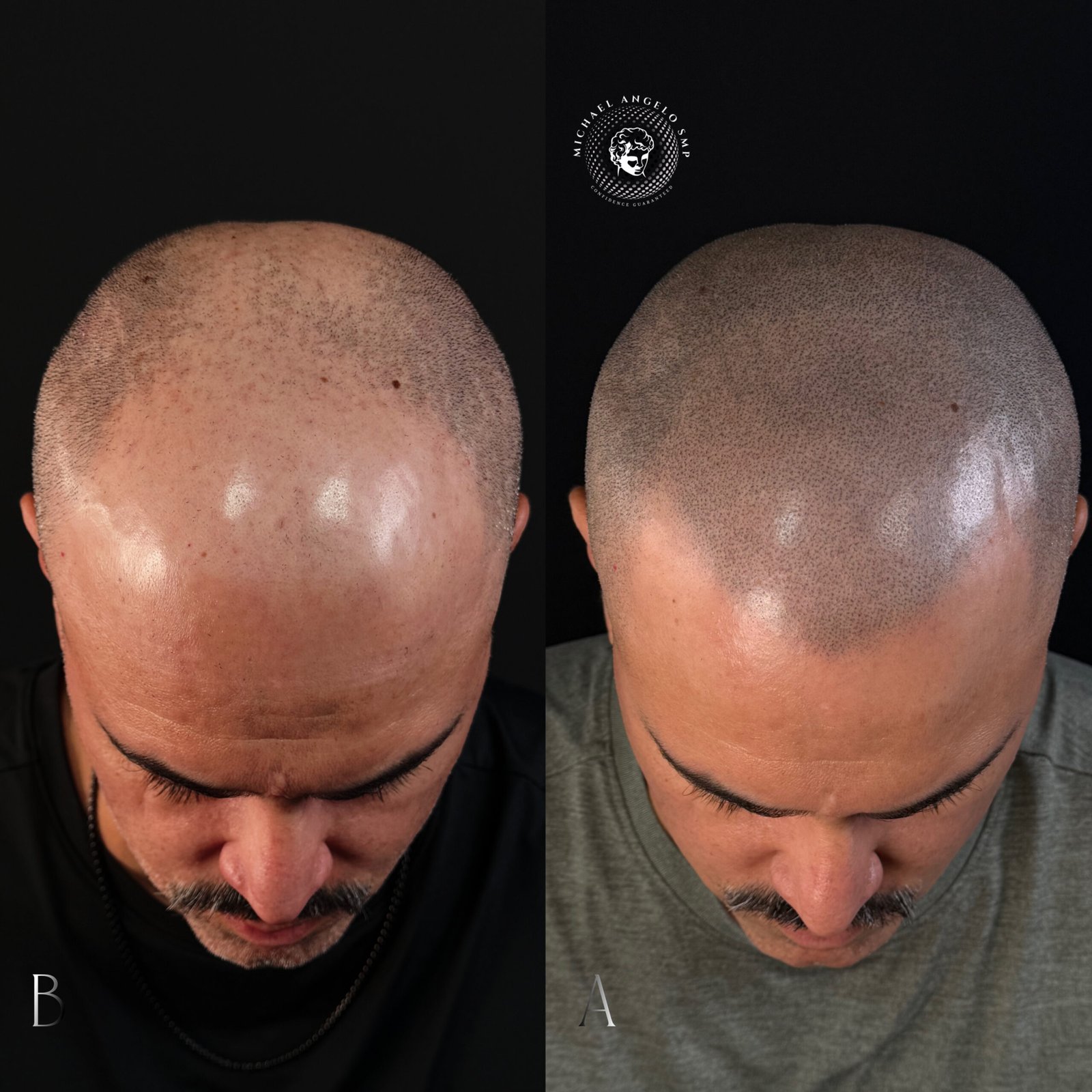 9 Shaved head hairline SMP result