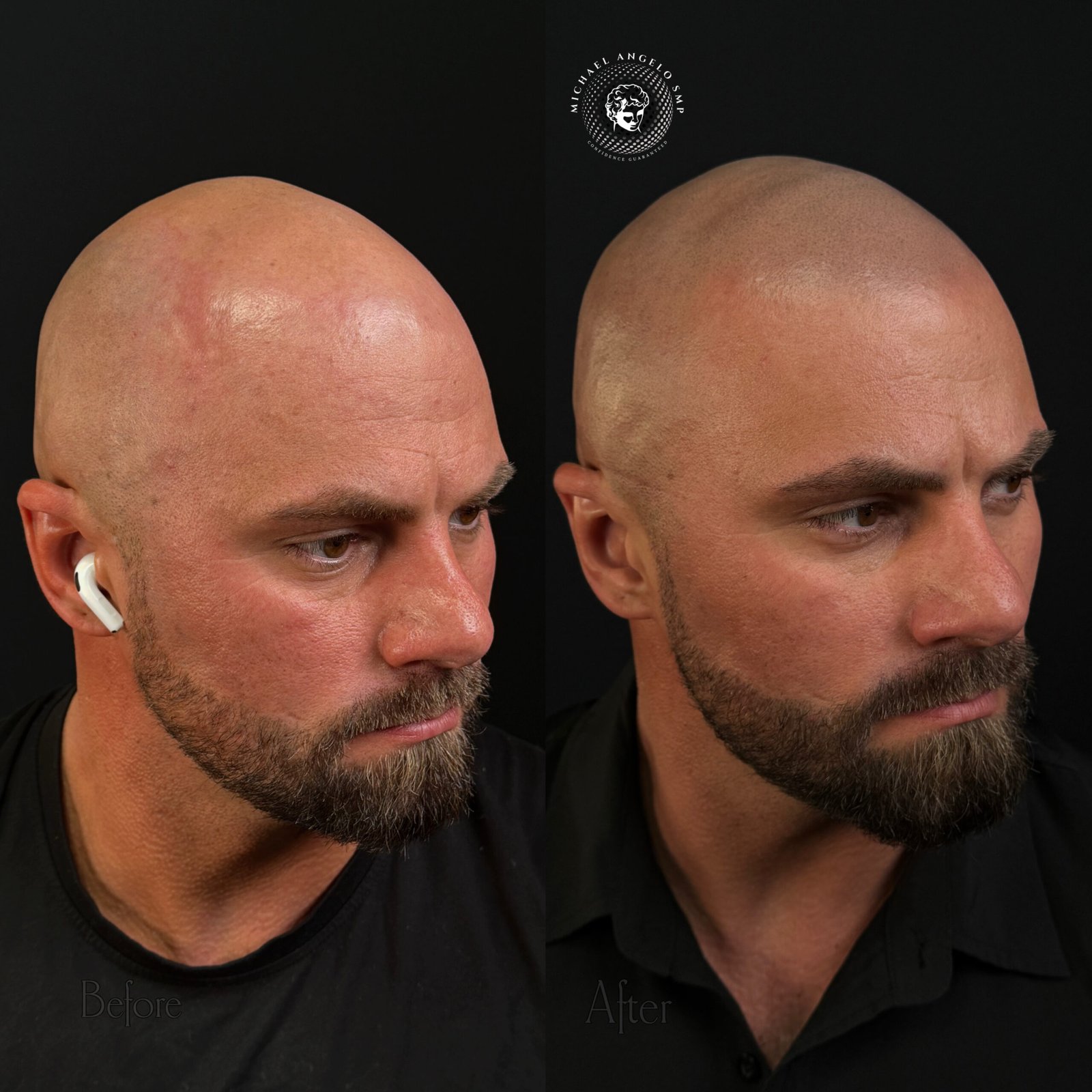 15 Full shaved head SMP transformation