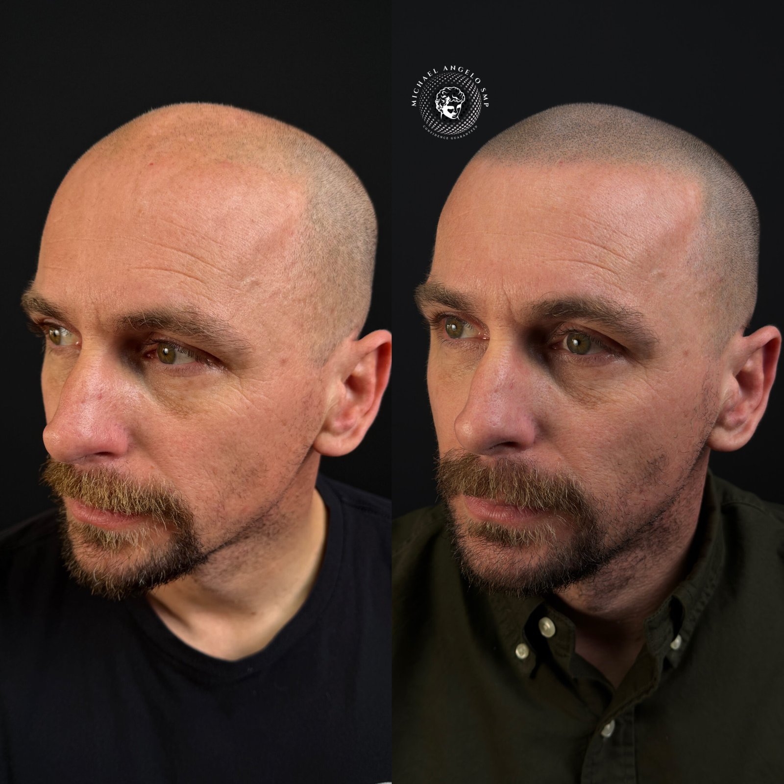 Shaved head scalp micropigmentation before and after transformation