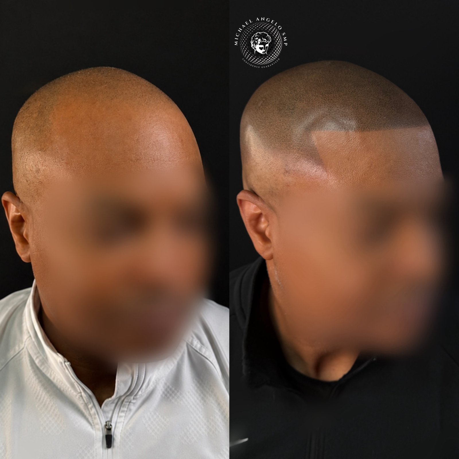 8 Natural scalp micropigmentation result