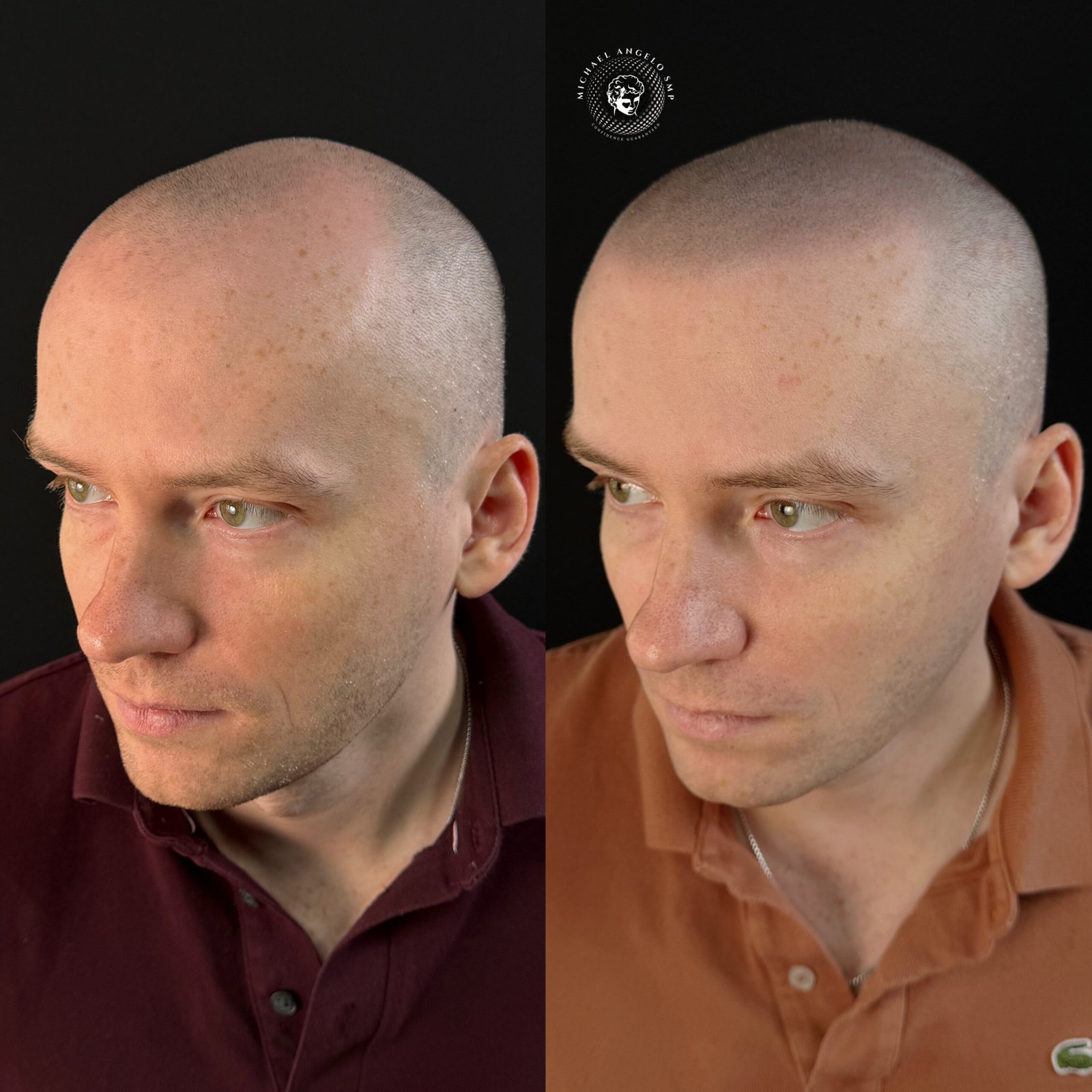 Scalp micropigmentation before and after result in Austin Texas