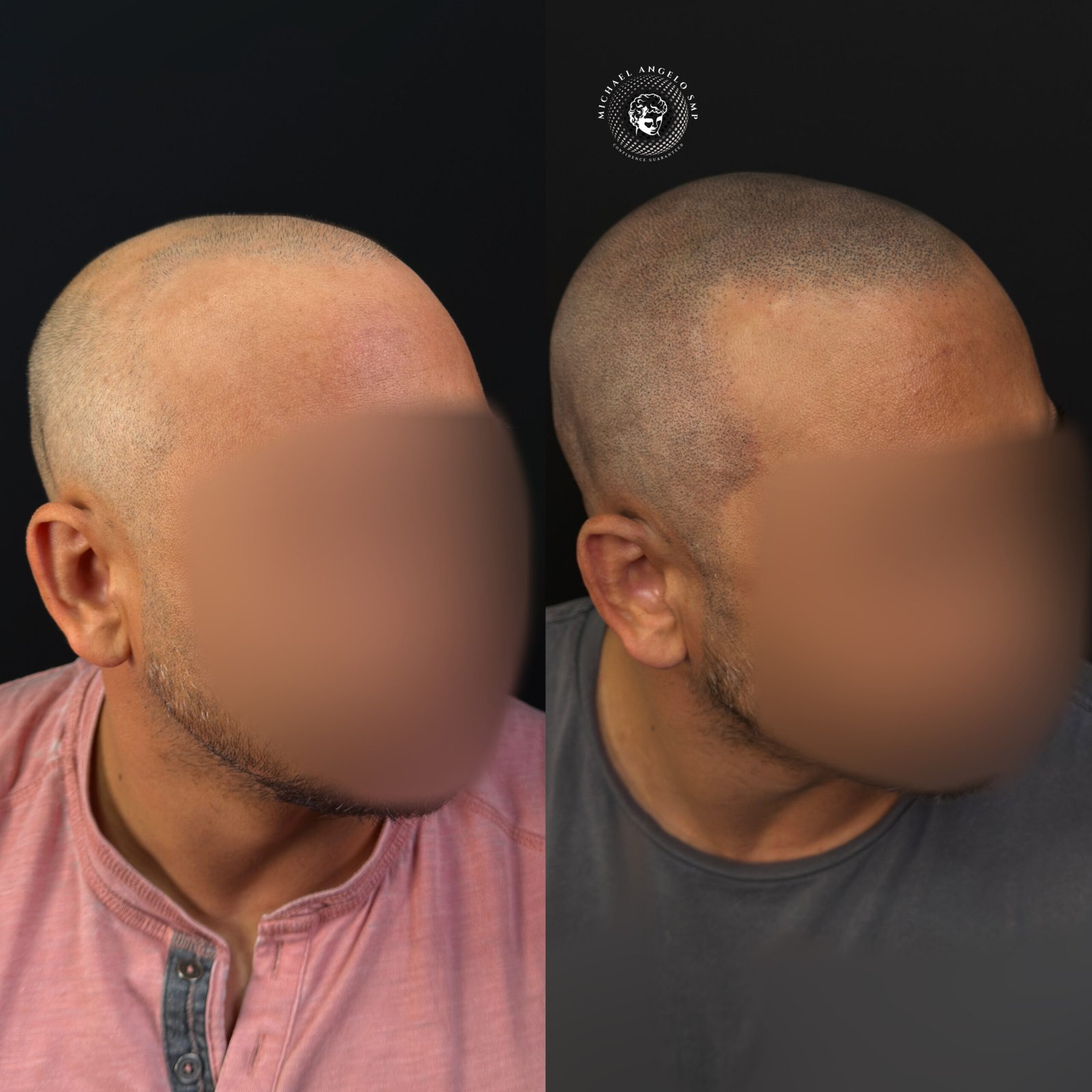 16 Scalp micropigmentation before and after
