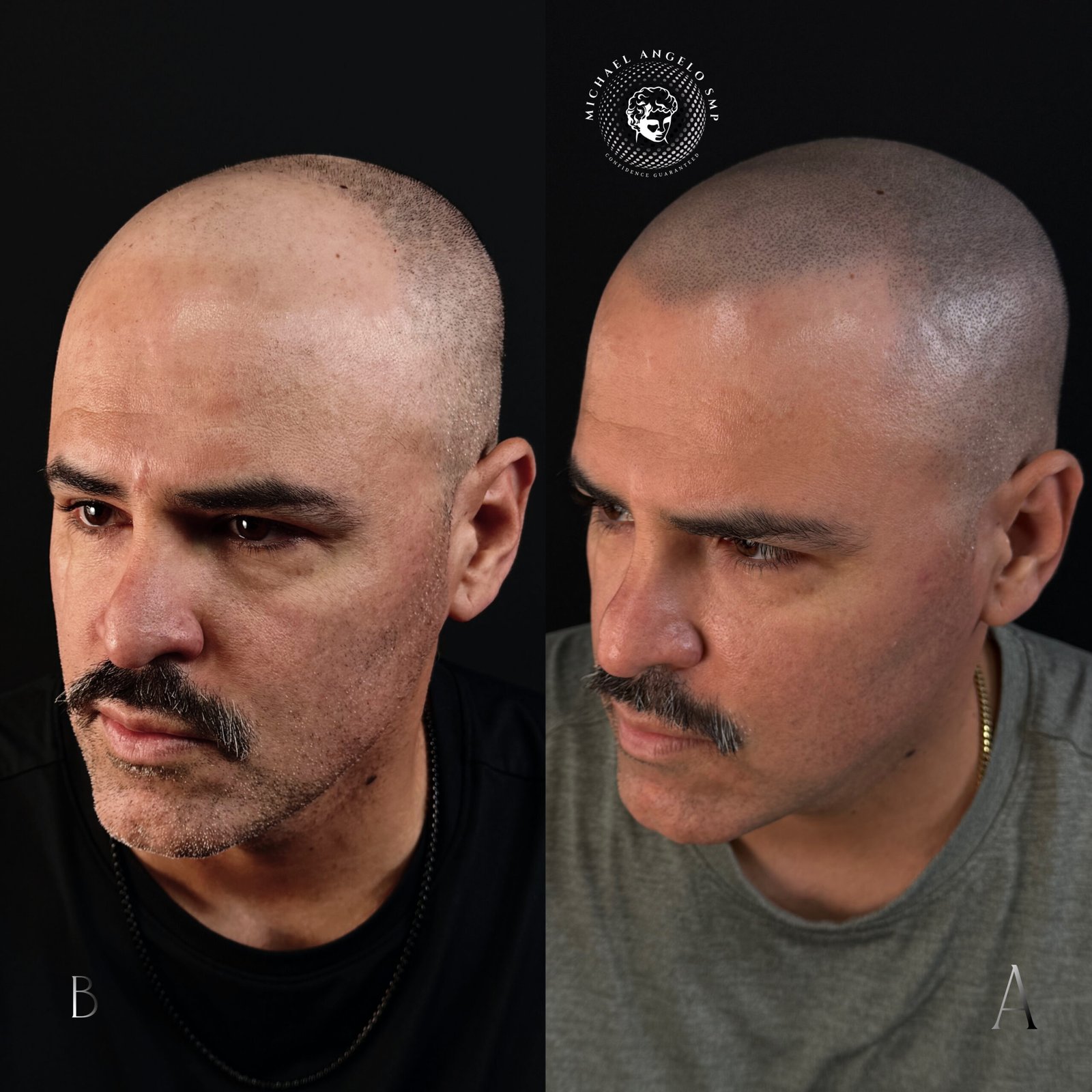 11 Shaved head scalp micropigmentation before and after