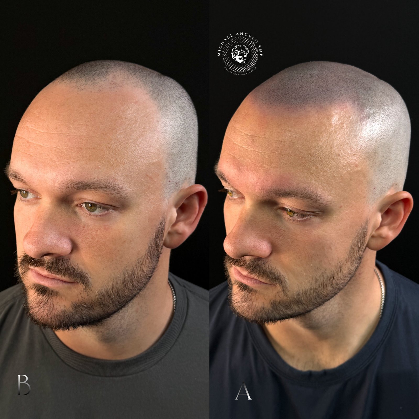 Natural scalp micropigmentation before and after
