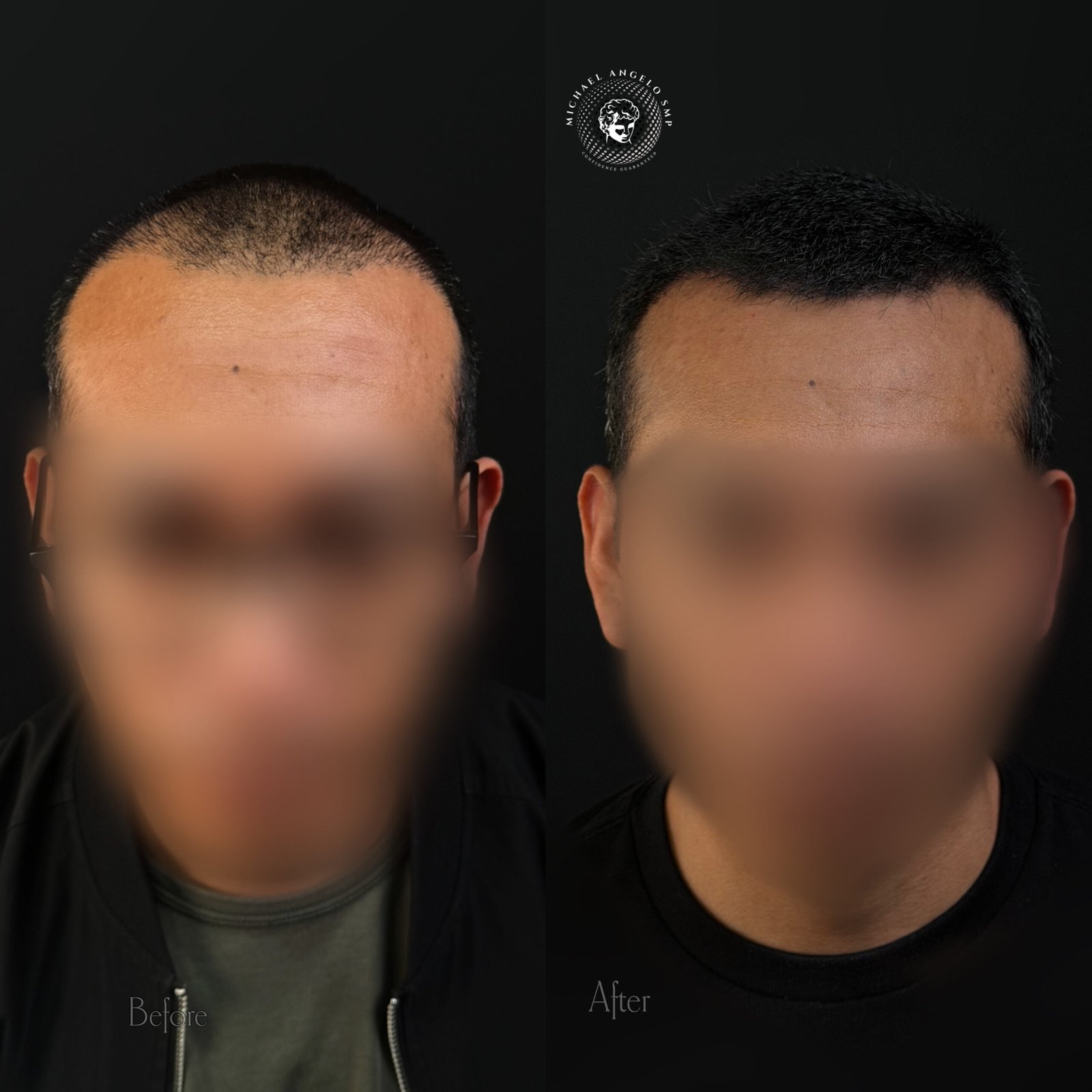Hair transplant and scalp micropigmentation density before and after result