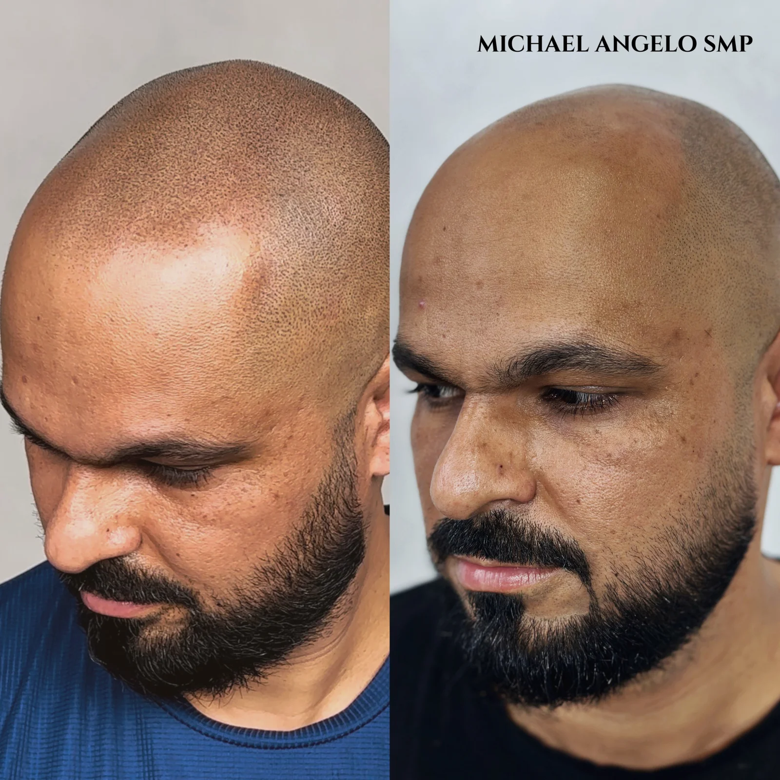 18 Scalp micropigmentation client result